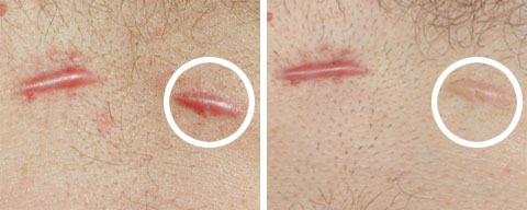 Keloid before and after steroid injection